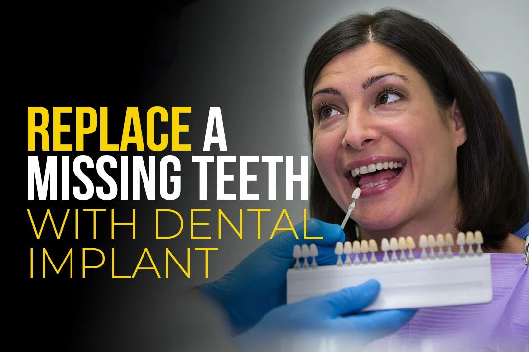 Replace a Missing Teeth with Dental Implant