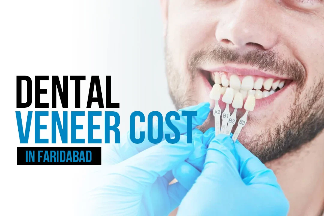 Dental Veneer Cost in Faridabad