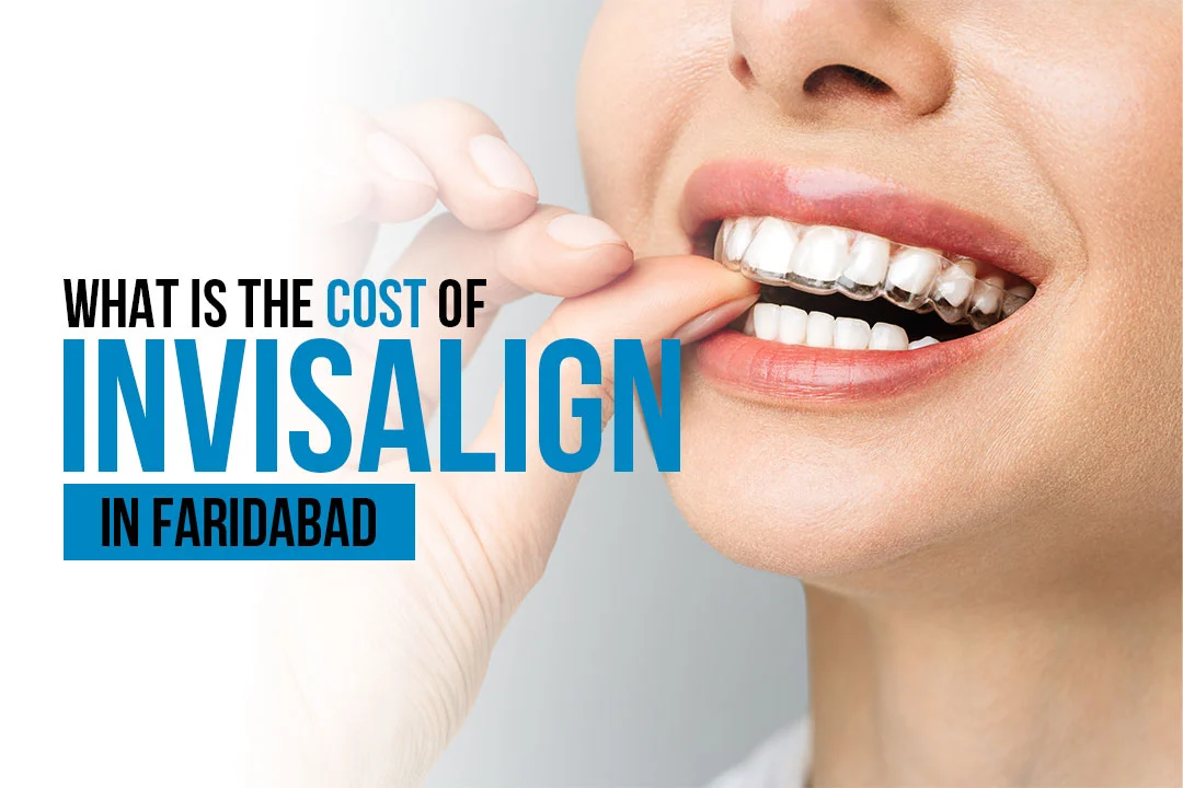 What is the Cost of Invisalign in Faridabad