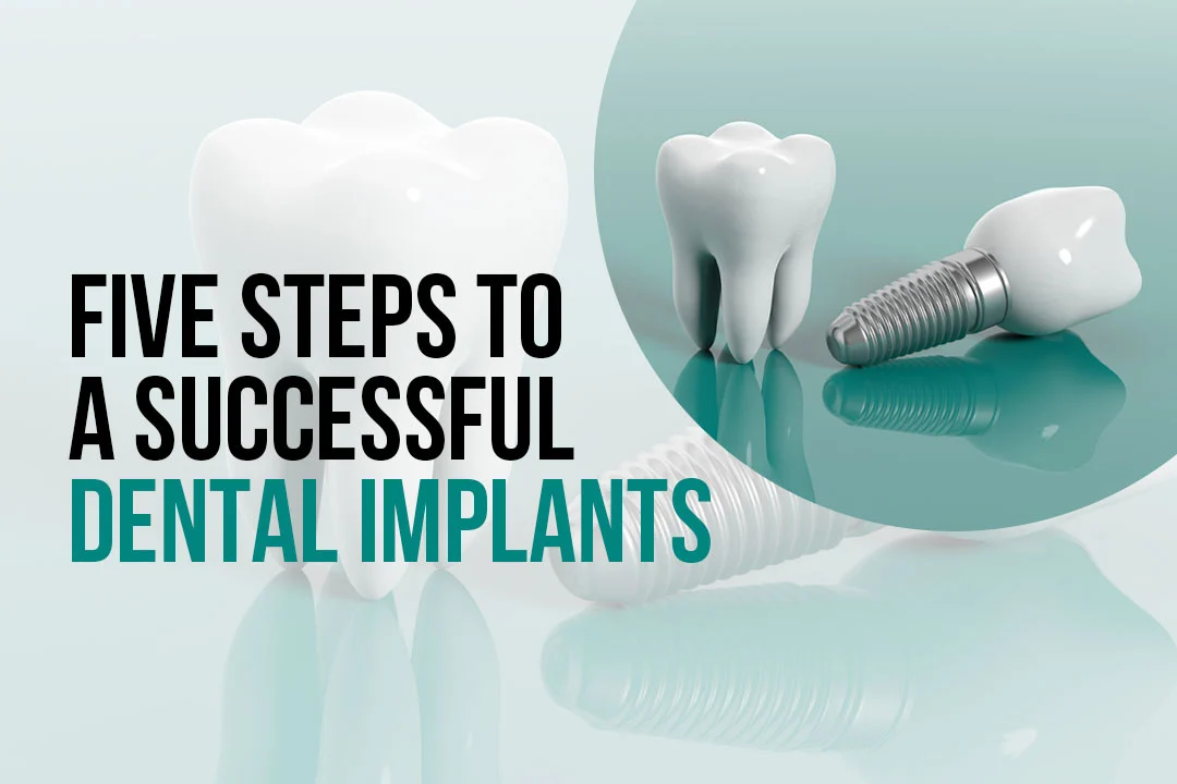 Five Steps to a Successful Dental Implants