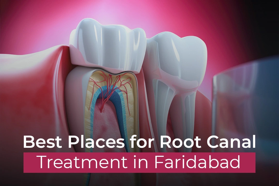 Root Canal Treatment in Faridabad