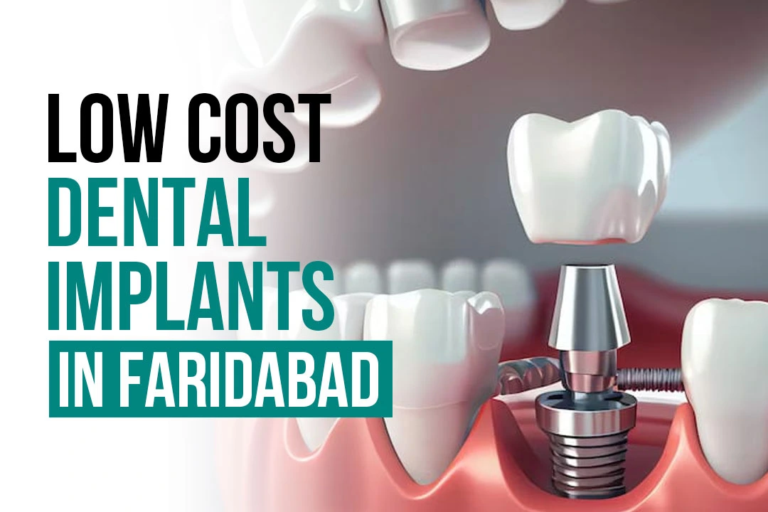 Low-Cost Dental Implants in Faridabad