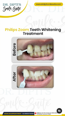 Philips Zoom Whitening Treatment
