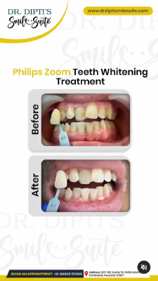teeth whitening Treatment