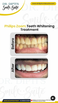 teeth whitening Treatment in faridabad